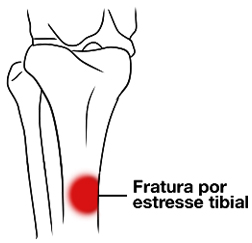 Ilustração representando o local onde a fratura por stress acontece