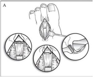 Correção em caso de rompimento da “Plantar Plate”.