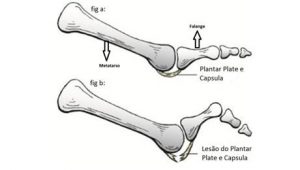 Figura 1 a- sem lesão "Plantar Plate"; b-com lesão.