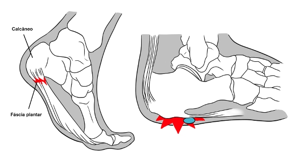 dor no calcanhar