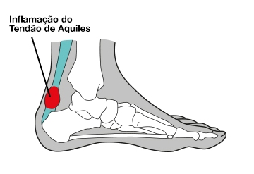 dor calcanhar tendao aquiles