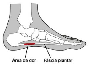 fascite-plantar