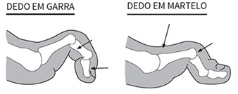 Dedo em garra / Dedo em martelo