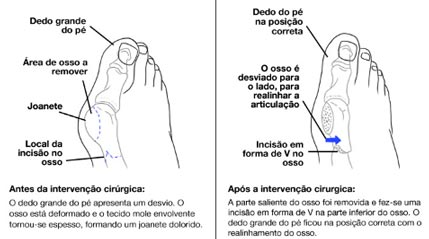 Imagem com a estrutura óssea do pé mostrando a região afetada pela joanete.