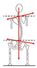 Imagem de um sistema locomotor torto devido a diferença de membros.