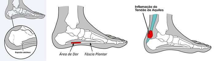 Imagem ilustrativa das áreas afetadas pelo esporão, fascite plantar e tendinite