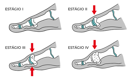 Ilustração mostrando os quatro estágios do hálux rígido